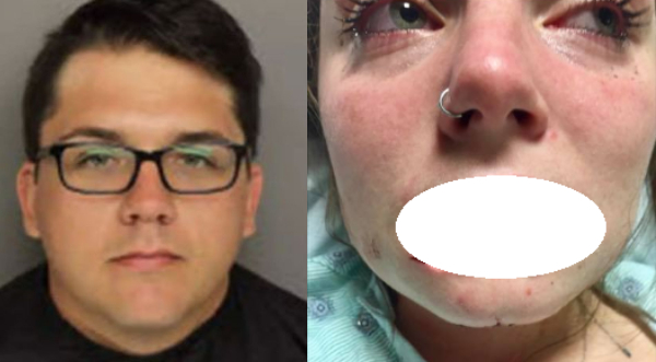 Man bites off girlfriend’s lip for cheating (graphic photos)