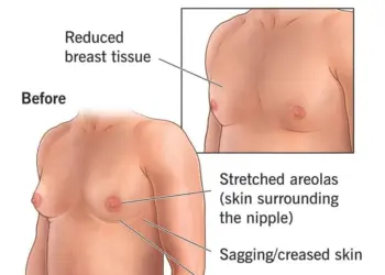 How To Get Gynecomastia Surgery Covered By Insurance In 2024