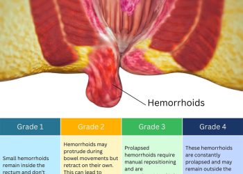 External Pile (Hemorrhoids) Appearance and Pictures, Causes & Treatment